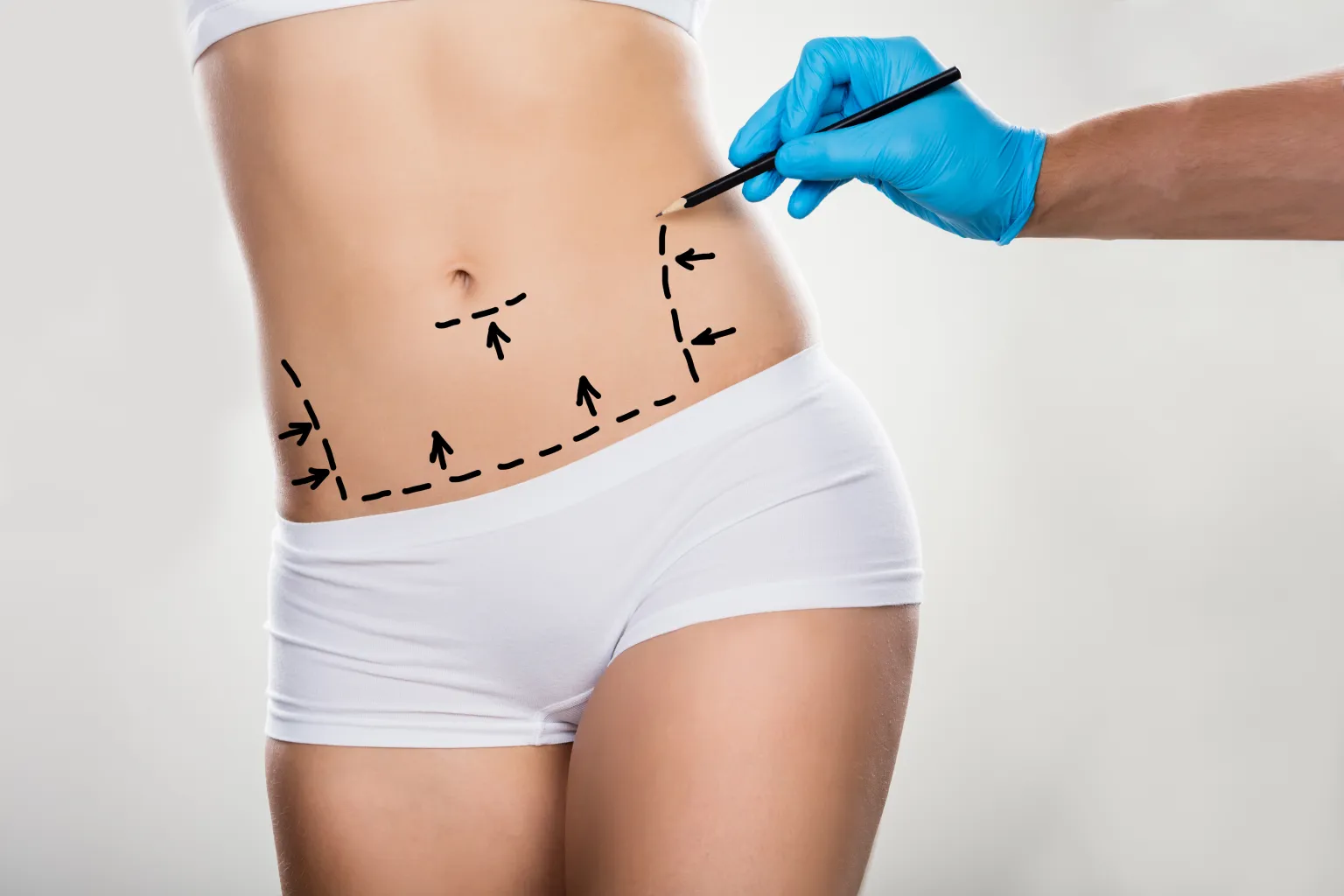 Abdominoplastía